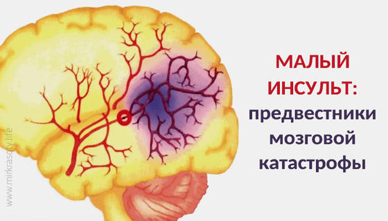 Малый инсульт – предвестники мозговой катастрофы