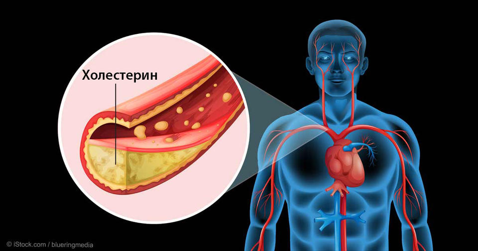 6 тревожных признаков, что в вашей крови слишком много холестерина