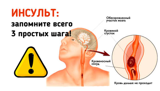 Инсульт: три шага, чтобы спасти жизнь себе или близким