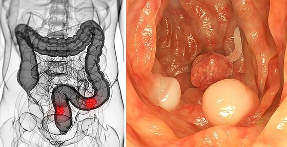 Эта штука может убить 93% рака толстой кишки за 2 суток! 