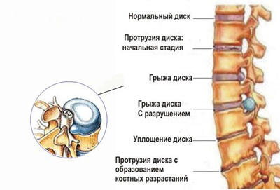 Чтобы спина не болела никогда, попробуйте 1 из 4 этих упражнений