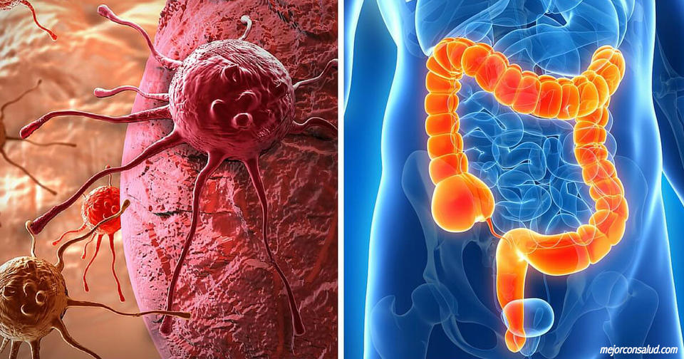 Эта штука может убить 93% рака толстой кишки за 2 суток! 