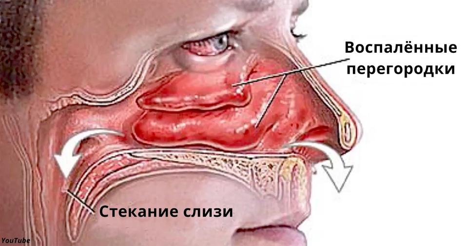 Есть 3 способа избавиться от насморка за 30 минут! Вот как