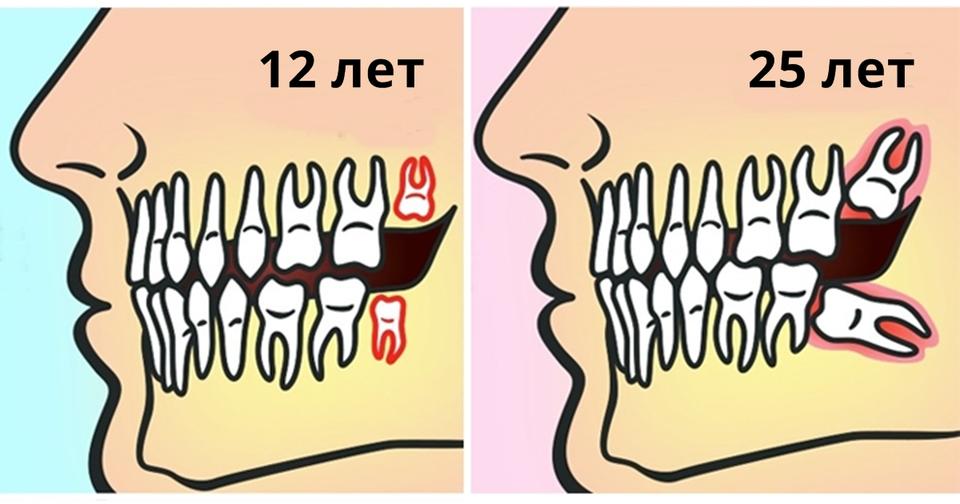 Вот почему зубы мудрости следует удалять до 25 лет!