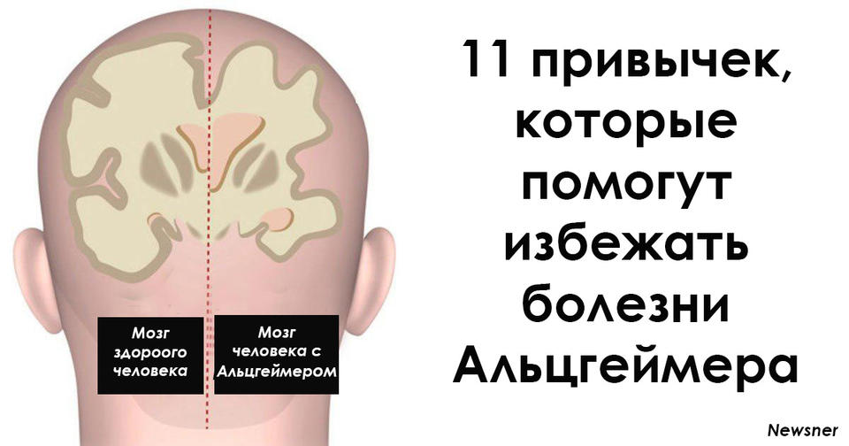 Мозги проверяем. Юмор про болезнь Альцгеймера. Про Альцгеймера приколы картинки. Шутка по Альцгеймера. Альцгеймер или Паркинсон анекдот.