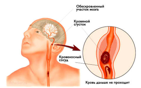 Инсульт: запомните 3 простых шага, чтобы спасти жизнь себе или близким