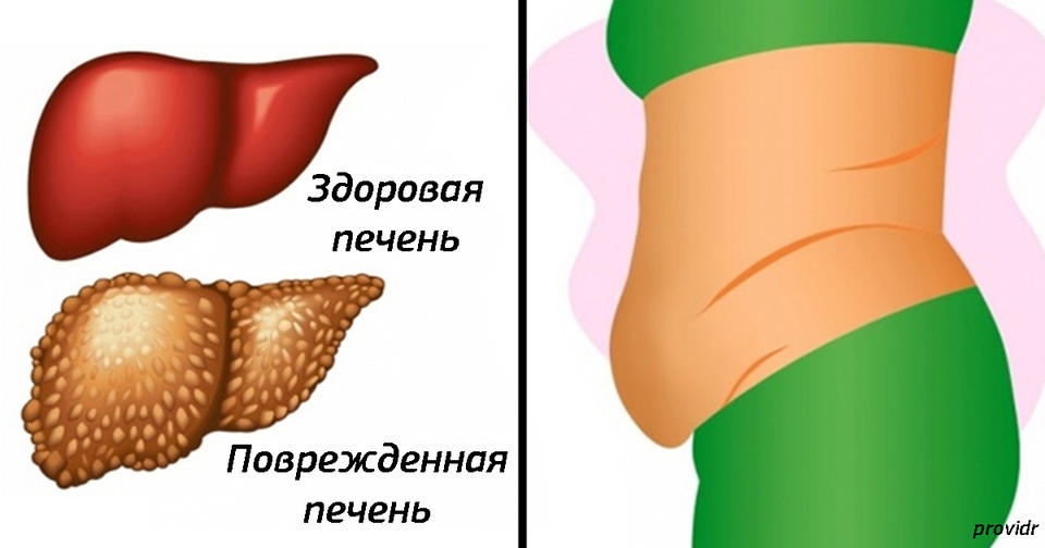 Калл при циррозе печени.