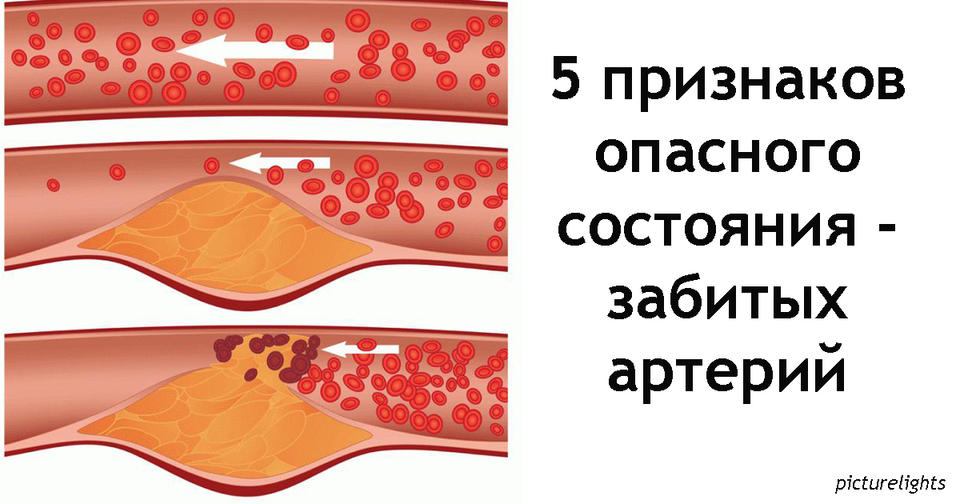 5 тревожных признаков, что ваши артерии уже забиты бляшками   и пора срочно что то делать! Не игнорируйте их!