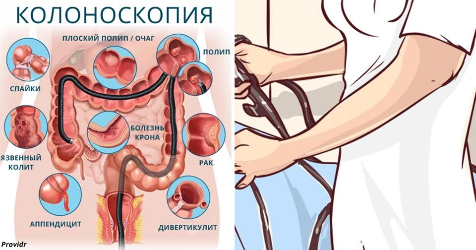 Если врач назначит вам колоноскопию, скажите ему следующее Деликатная, но важная тема.