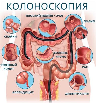 Если врач назначит вам колоноскопию, скажите ему следующее Деликатная, но важная тема.