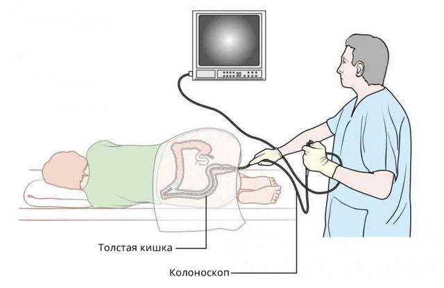 Если врач назначит вам колоноскопию, скажите ему следующее Деликатная, но важная тема.