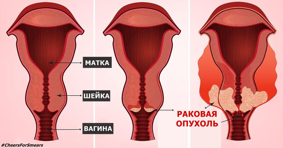 5 ранних признаков рака шейки матки — болезни, которая забирает жизни миллионов