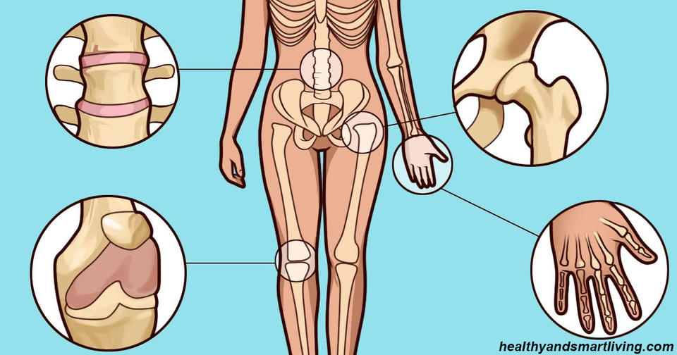 7 ранних симптомов артрита, которые нельзя игнорировать