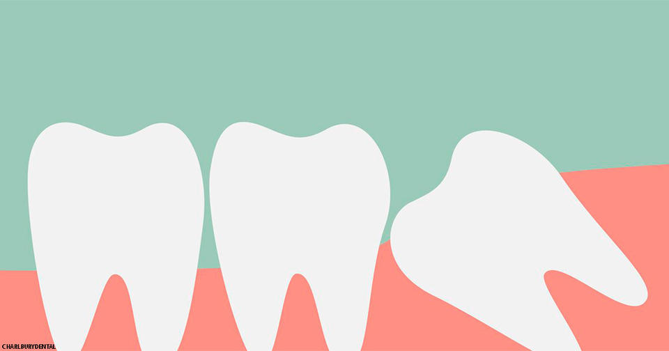 Вот все безопасные способы облегчить боль от зуба мудрости