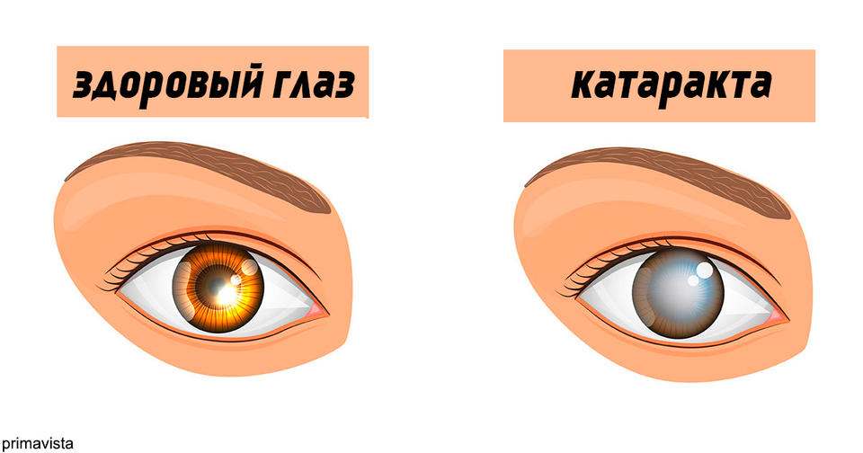 7 безмолвных признаков катаракты, с которыми может столкнуться каждый