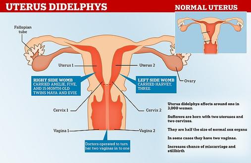 Женщина с двумя вагинами и двумя матками уже родила четверо детей