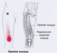 Карта триггеров: точки боли и точки напряжения мышц 