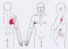Карта триггеров: точки боли и точки напряжения мышц 