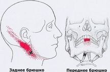 Карта триггеров: точки боли и точки напряжения мышц 