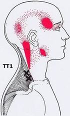 Карта триггеров: точки боли и точки напряжения мышц 