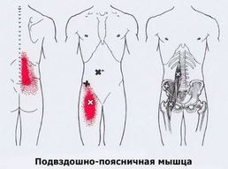 Карта триггеров: точки боли и точки напряжения мышц 