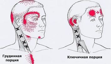 Карта триггеров: точки боли и точки напряжения мышц 