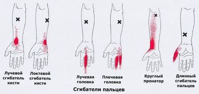 Карта триггеров: точки боли и точки напряжения мышц 