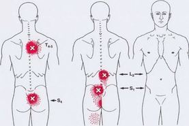 Карта триггеров: точки боли и точки напряжения мышц 