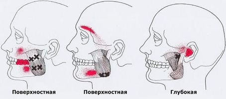 Карта триггеров: точки боли и точки напряжения мышц 