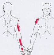 Карта триггеров: точки боли и точки напряжения мышц 