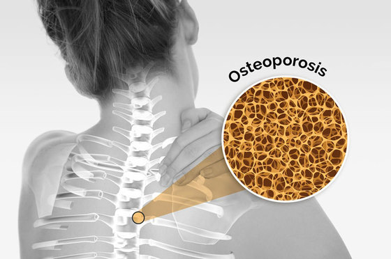 Правда об остеопорозе