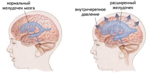 Повышенное внутричерепное давление: Как себе помочь 