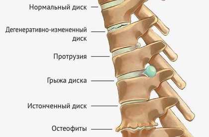 Адекватная нагрузка на позвоночник: как правильно сидеть и стоять