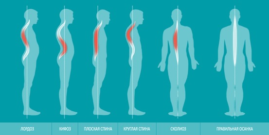 Поясничный лордоз: Как распознать и ЧТо делать