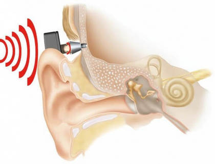 ADHEAR — еще один безопасный слуховой аппарат на базе костной проводимости звука