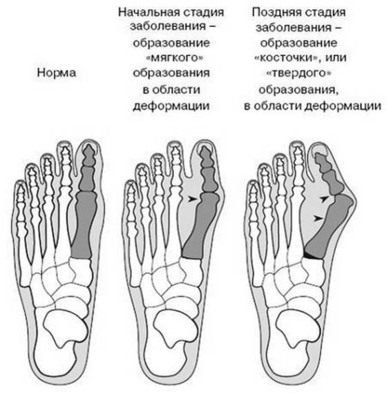 Эффективные упражнения от косточек на ногах