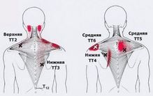 Карта триггеров: точки боли и точки напряжения мышц 