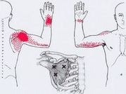 Карта триггеров: точки боли и точки напряжения мышц 