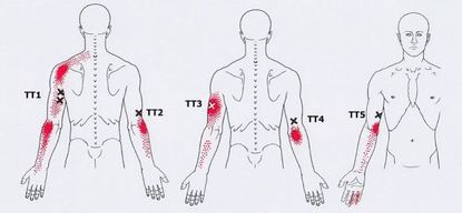 Карта триггеров: точки боли и точки напряжения мышц 