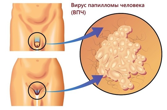 Лечение остроконечных кондилом народными средствами 