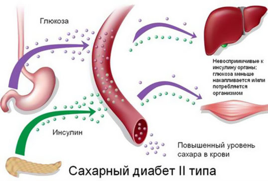 КАК вылечить диабет 2 го типа БЕЗ медикаментов!