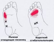 Карта триггеров: точки боли и точки напряжения мышц 