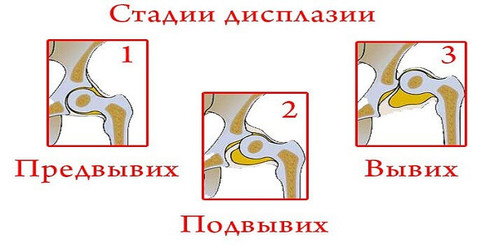 Синдром соединительнотканной дисплазии у детей и взрослых: причины и симптомы, стадии и лечение